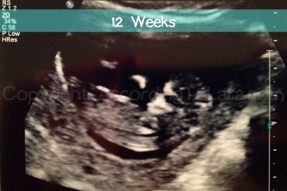12WeeksUltrasound